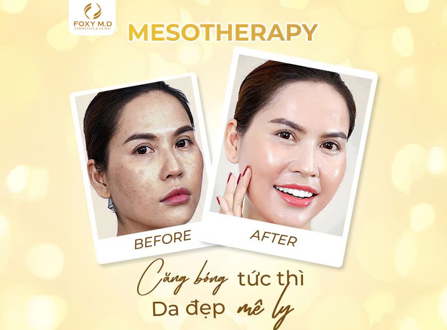 Mesotherapy Căng Bóng Tức Thì - Da Đẹp Mê Ly, Biến Hóa Như Ý!
